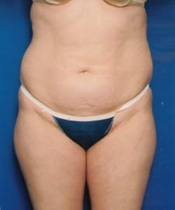 Case of the Month Body | May &#8211; Tummy Tuck