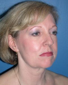 Case of the Month Face | May &#8211;  Facelift, Facial Fat Grafting and Browlift