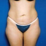 Case of the Month Body | June &#8211; Tummy Tuck