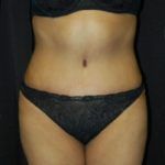 Case of the Month Body | July &#8211; Abdominoplasty