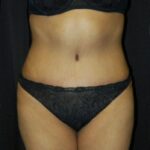 Case of the Month Body | July &#8211; Abdominoplasty