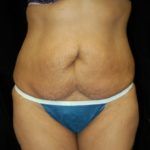 Case of the Month Body | July &#8211; Abdominoplasty