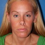 Case of the Month Face | July &#8211; Revision Rhinoplasty