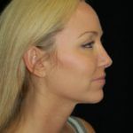 Case of the Month Face | August &#8211; Rhinoplasty (Nose Job Surgery)