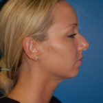 Case of the Month Face | August &#8211; Rhinoplasty (Nose Job Surgery)