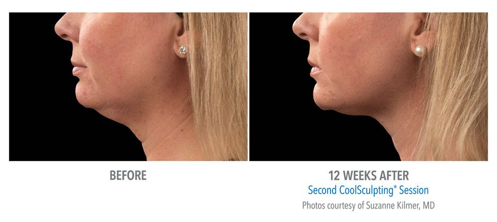coolsculpting chin before and after