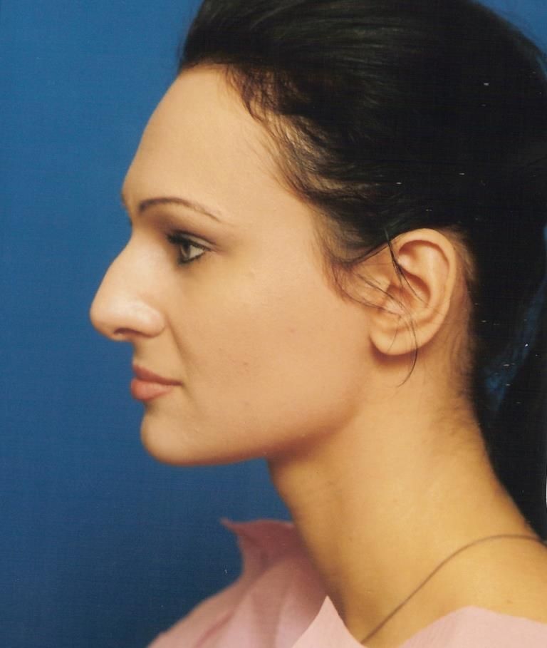 Rhinoplasty Case