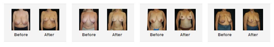 Breast Reduction Surgery Before and After Photos