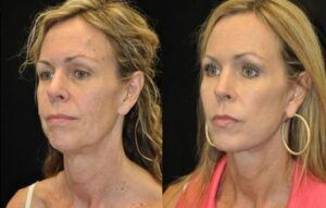 facial rejuvenation (facelift & facial fat grafting) before & after pictures 2