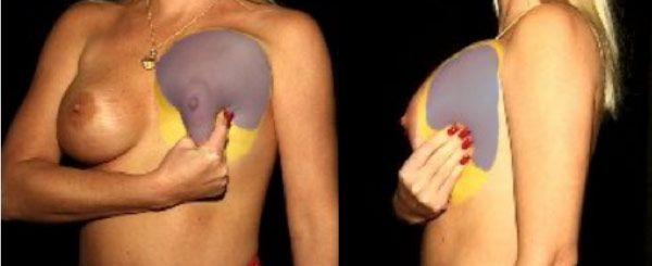 Breast Massage