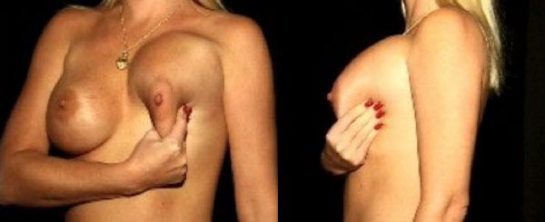 Breast Massage