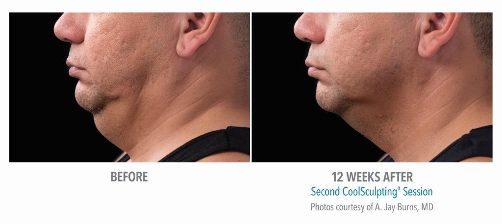  Neck Fat Reduction with CoolSculpting - Special Offer $200 Off 1st Treatment