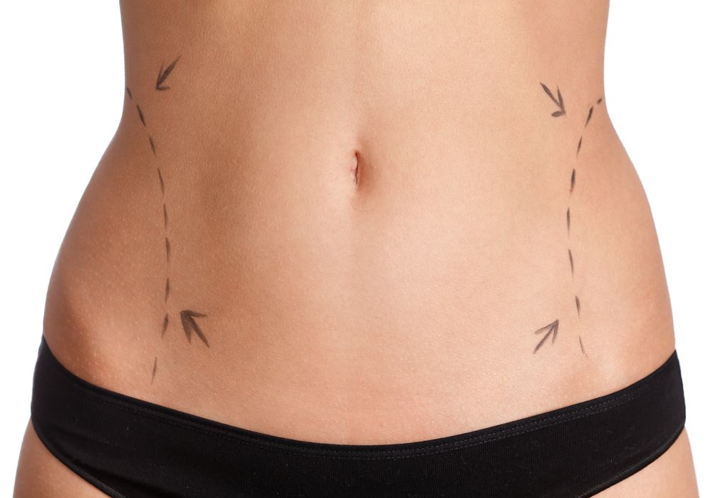 Laser Liposuction vs. Abdominoplasty (Tummy Tuck Surgery)