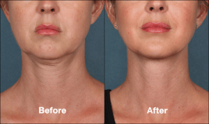 Kybella® </br><span class="smh1">Beverly Hills</span>