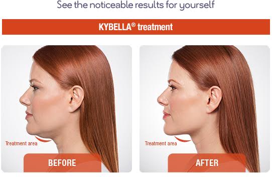 Kybella® </br><span class="smh1">Beverly Hills</span>