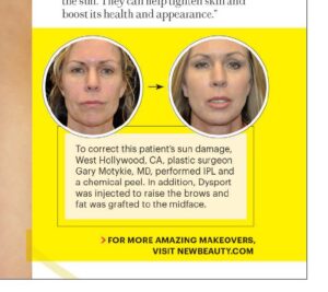 Dr. Motykie&#8217;s Sun Damage Correction Before &#038; After Photos in New Beauty Magazine