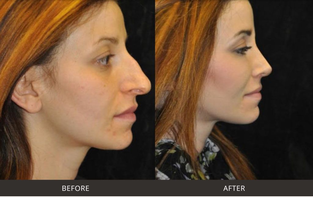 Dr Motykie before after rhinoplasty nose surgery beverly hills 1
