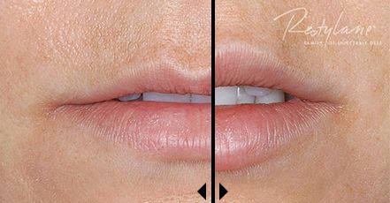 Lip Augmentation Enhancement Treatments