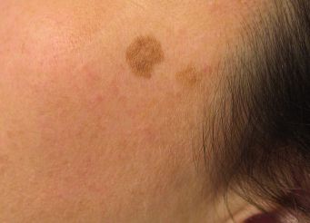 Remove Age Spots With Dermabrasion
