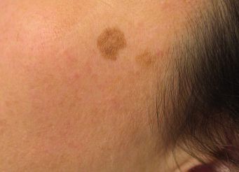 Remove Age Spots With Dermabrasion Beverly Hills Med Spa Los Angeles Ca Remove Age Spots With Dermabrasion Beverly Hills Med Spa Los Angeles Ca