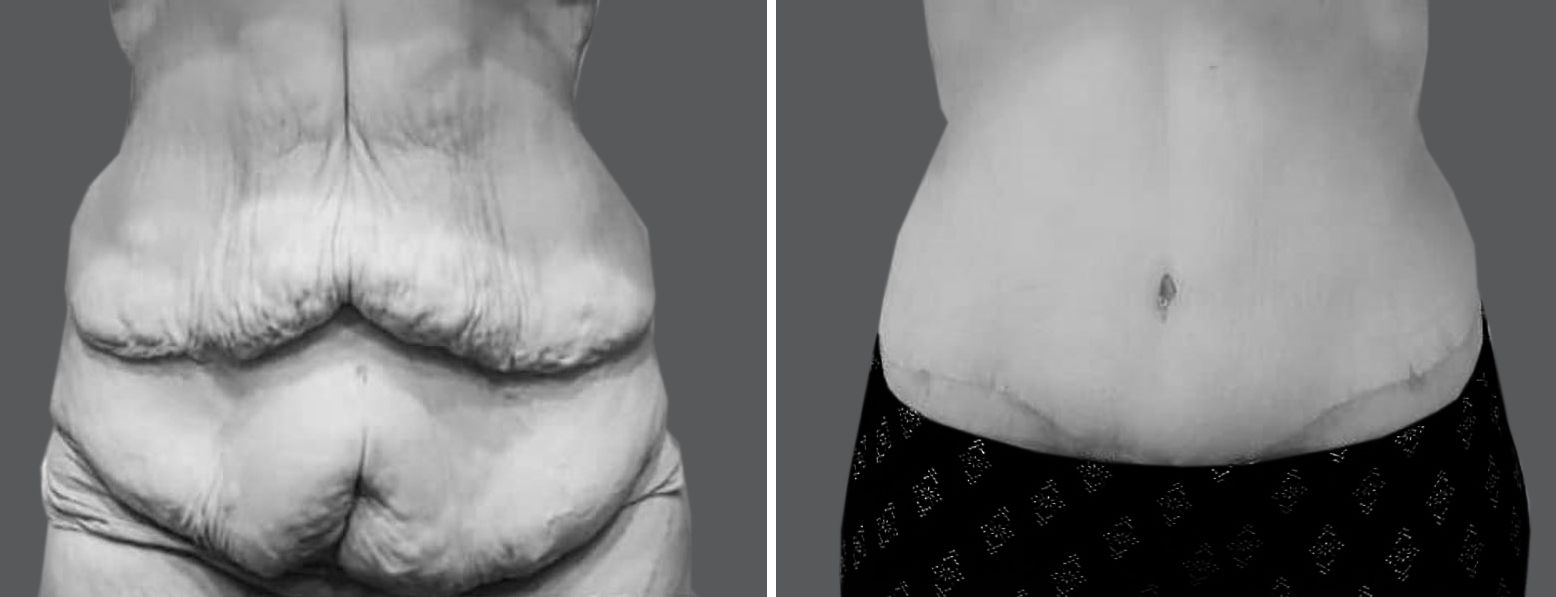 Body Contouring After Weight Loss Before and After Pictures Case