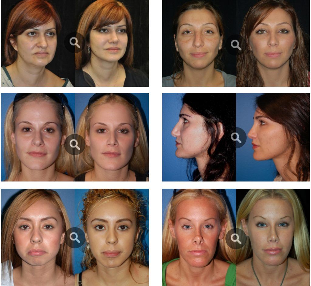 Facial Reshaping Surgery Before And After Photos