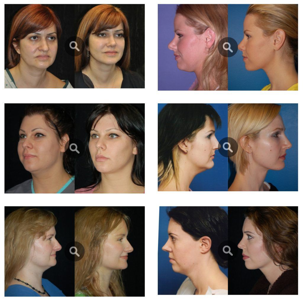 Neck Liposuction Plastic Surgery Before And After Photos