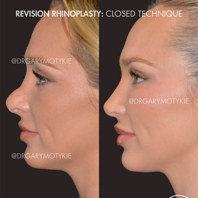 ponytail facelift, facial fat grafting, and rhinoplastY – 35