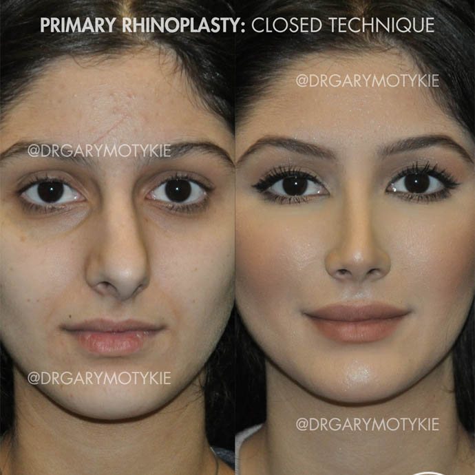 ponytail facelift, facial fat grafting, and rhinoplastY – 35