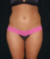 Liposuction case #4664