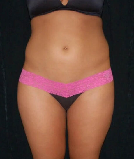 Liposuction case #4664