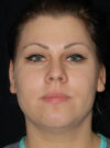 Buccal Fat Removal case #4105