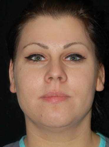 Buccal Fat Removal case #4105