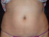 Coolsculpting case #4295