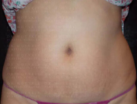 Coolsculpting case #4295