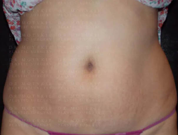 Coolsculpting case #4295