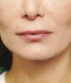 Lip Fillers case #4654