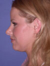 Neck Liposuction case #4922