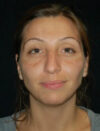 Facial Fat Grafting case #4479