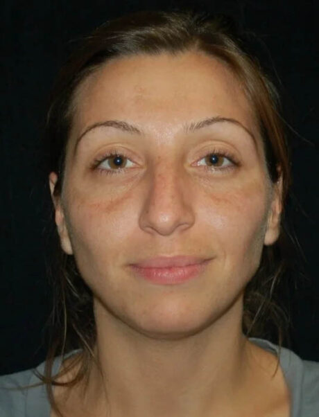 Facial Fat Grafting case #4479