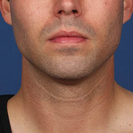 Kybella case #4617