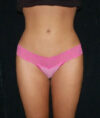Liposuction case #4664