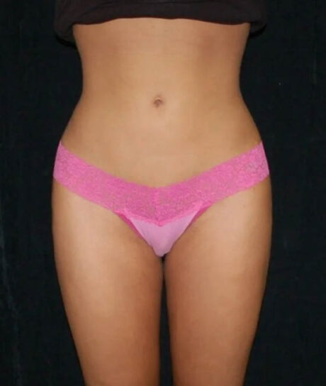 Liposuction case #4664