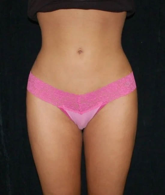 Liposuction case #4664