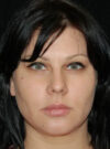 Buccal Fat Removal case #4105