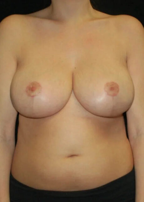 Breast Reduction case #4051