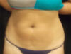Coolsculpting case #4295