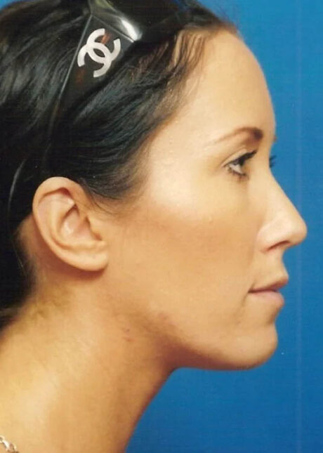 Chin Implant case #4176