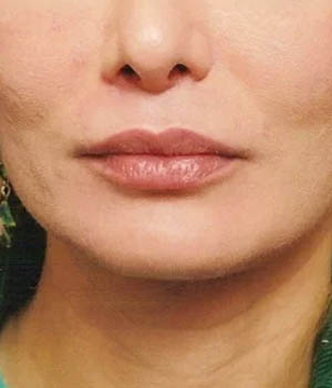 Lip Fillers case #4654