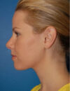 Neck Liposuction case #4922